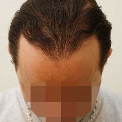 apres greffe cheveux kayihan 4