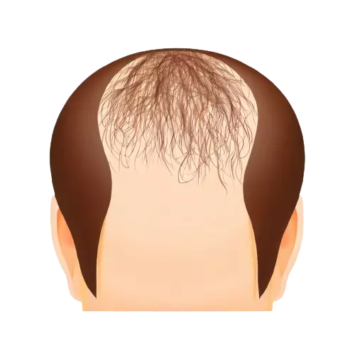 حلول تساقط الشعر