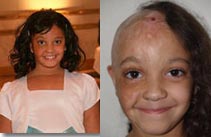 د. إبشتين، جراح هيرميد في ميامي يعيد البسمة لطفلة احترقت نصف فروة رأسها