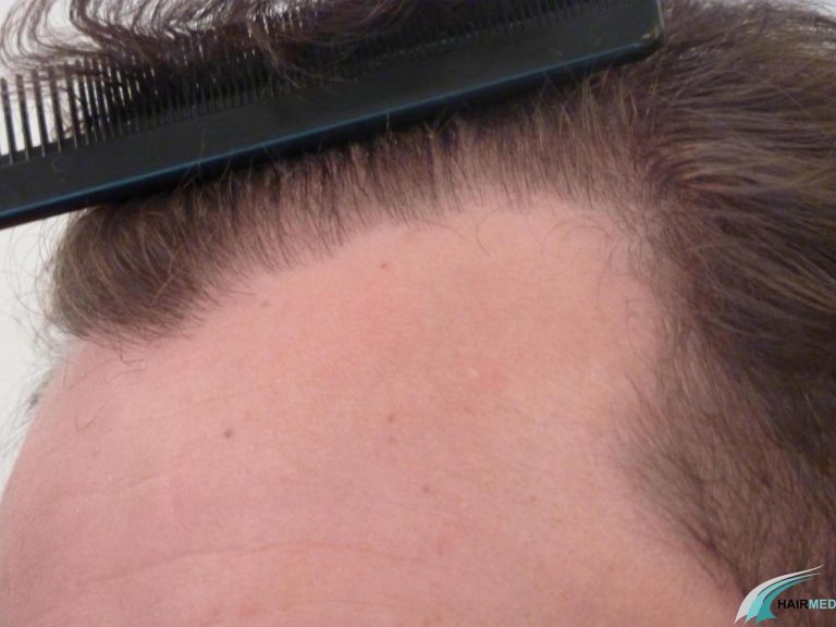 hairline hair transplant after a follicular unit transplantation by fut in istanbul by hairmed