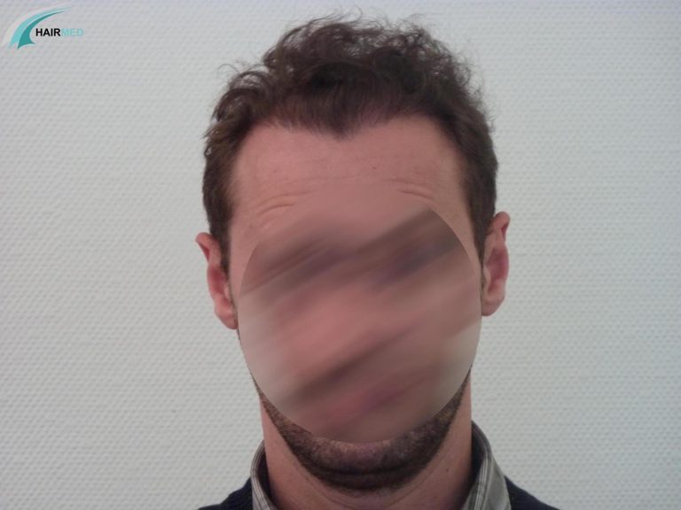 after a follicular unit transplantation by fut in istanbul by hairmed