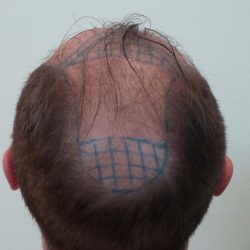 bac view of the vertex before fut