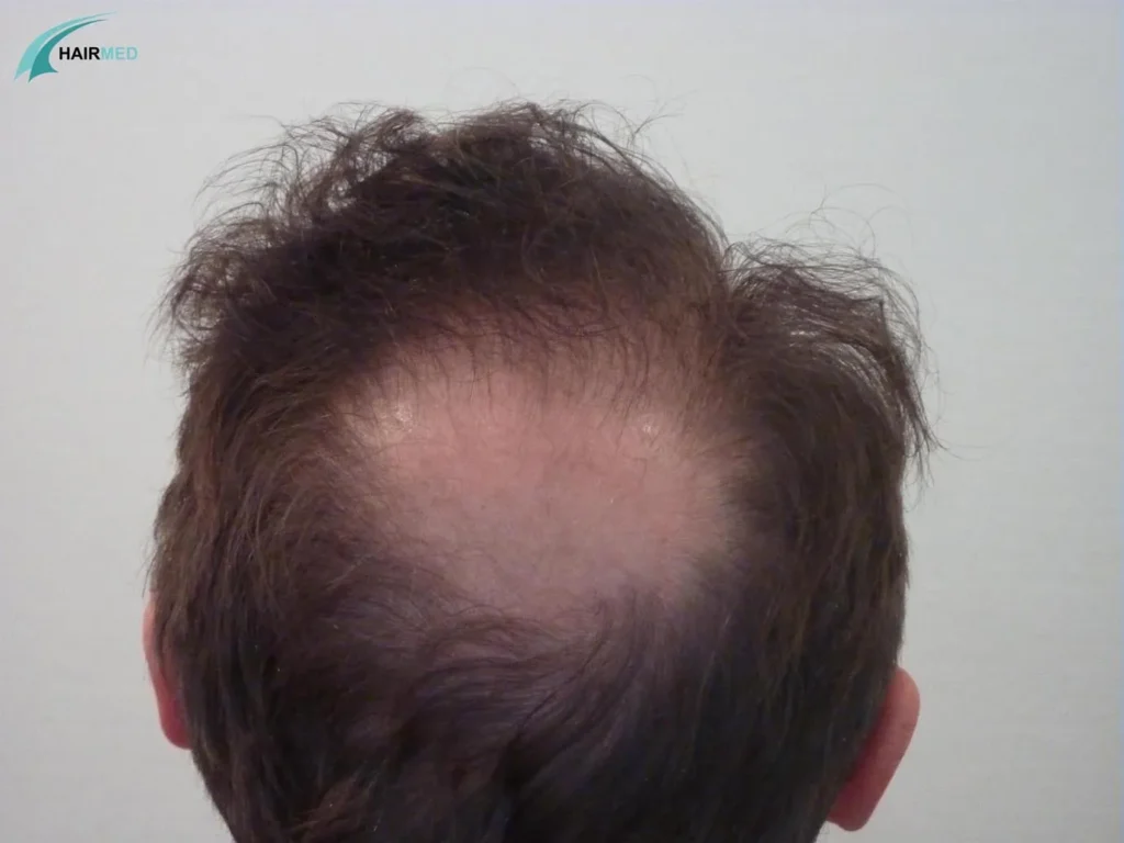 back view hair transplant istanbul dr beyhan 1