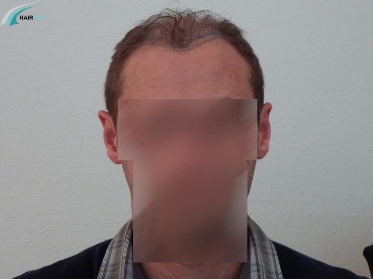 Before a hair transplant by Dr Beyhan in Turkey