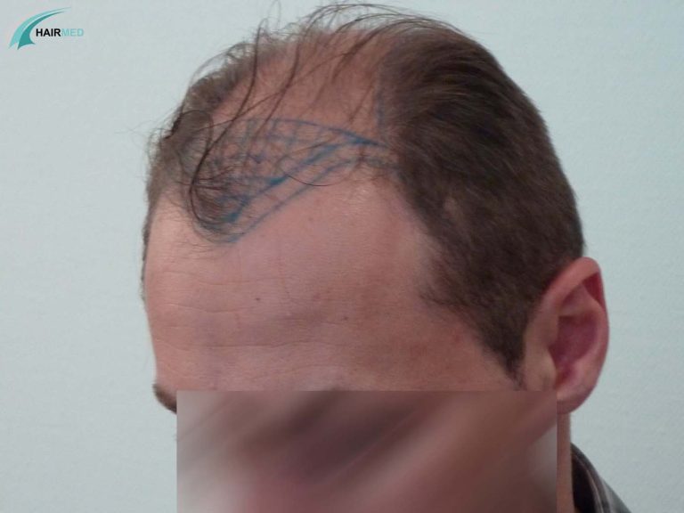 Three quartes view of a hair transplant design before the operation