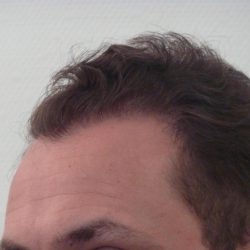 hairline 3000 grafts hair transplant design istanbul
