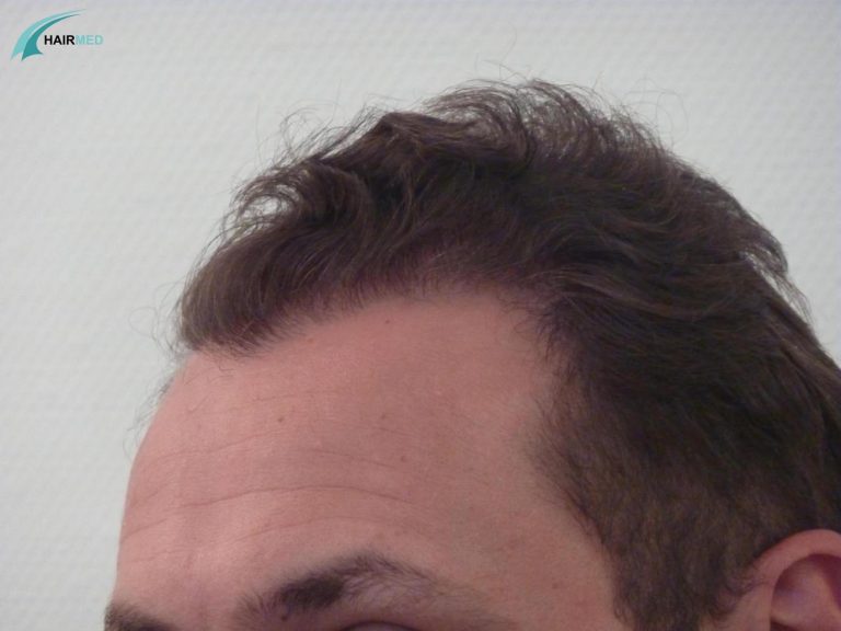 hairline hair transplant after a follicular unit transplantation by fut in istanbul by hairmed