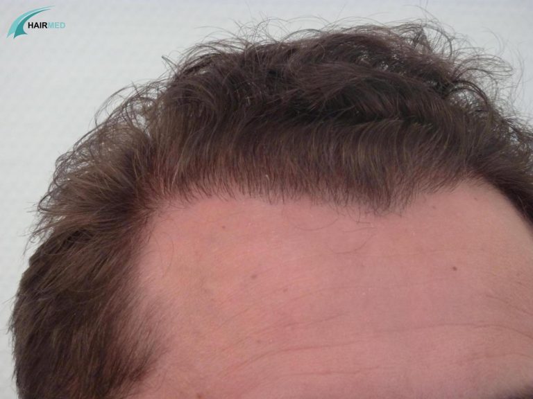 hairline hair transplant after a follicular unit transplantation by fut in istanbul by hairmed