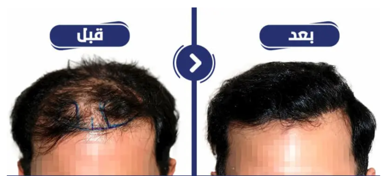 قبال متزايد من الأطباء الفرنسيين على عمليات زراعة الشعر في هيرميد