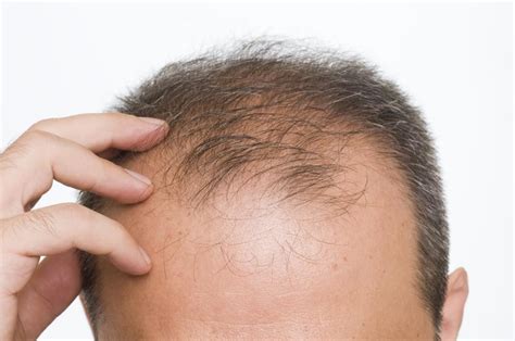 تساقط الشعر: فهم الأسباب واكتشاف الحلول للحفاظ على صحة شعرك