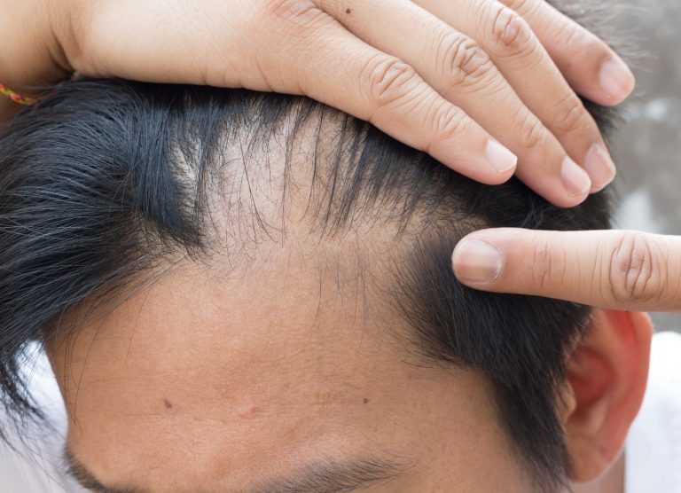 تساقط الشعر والصحة النفسية: تأثير فقدان الشعر على الحالة المزاجية