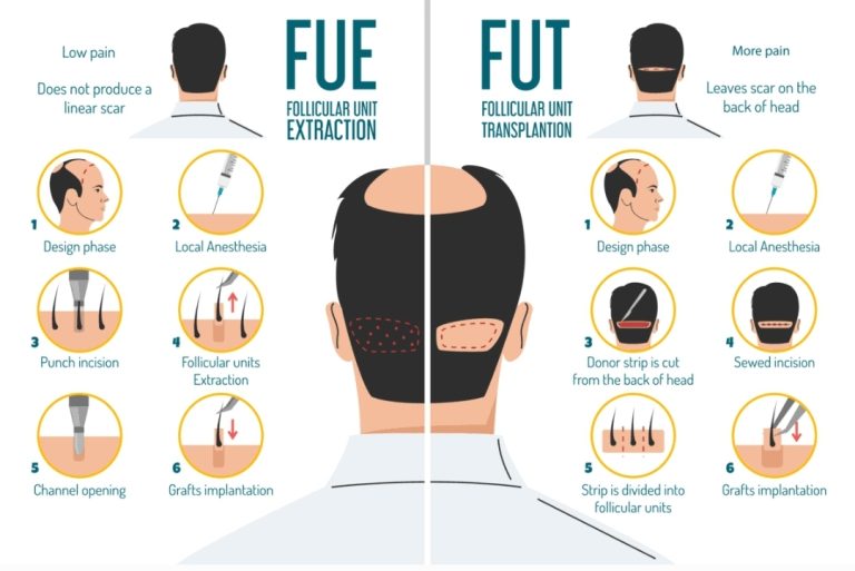 زراعة الشعر : فهم الفرق بين تقنية FUEو تقنية FUT
