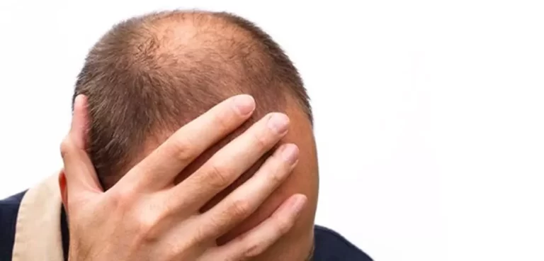 الحالة النفسية و تساقط الشعر : هل تسبب المشاكل النفسية فقدان الشعر ؟
