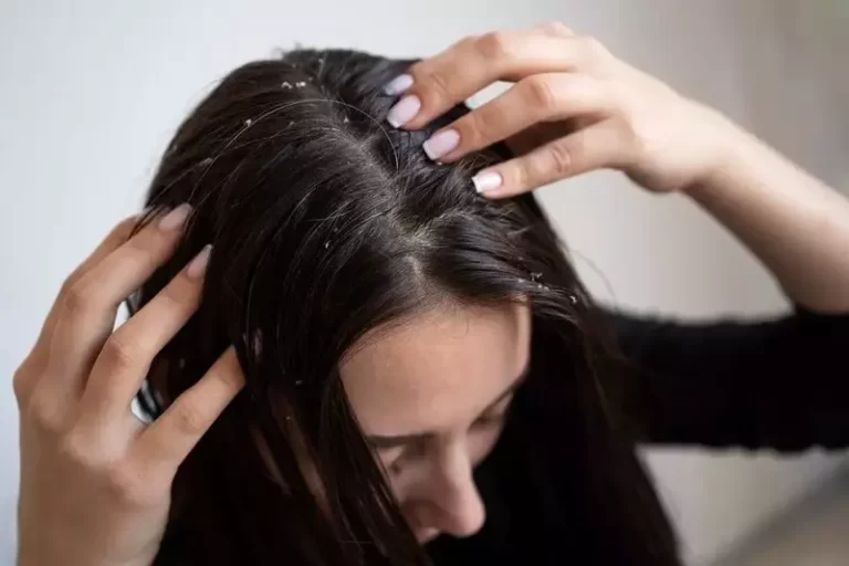 هل تسبب القشرة في فروة الرأس تساقط الشعر؟