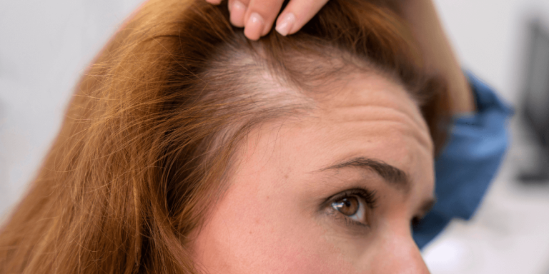 تساقط الشعر الجبهي الليفي: الأسباب والأعراض والعلاجات
