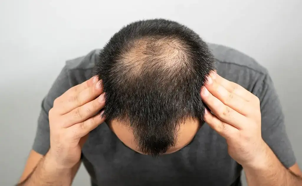 العامل الوراثي في تساقط الشعر
