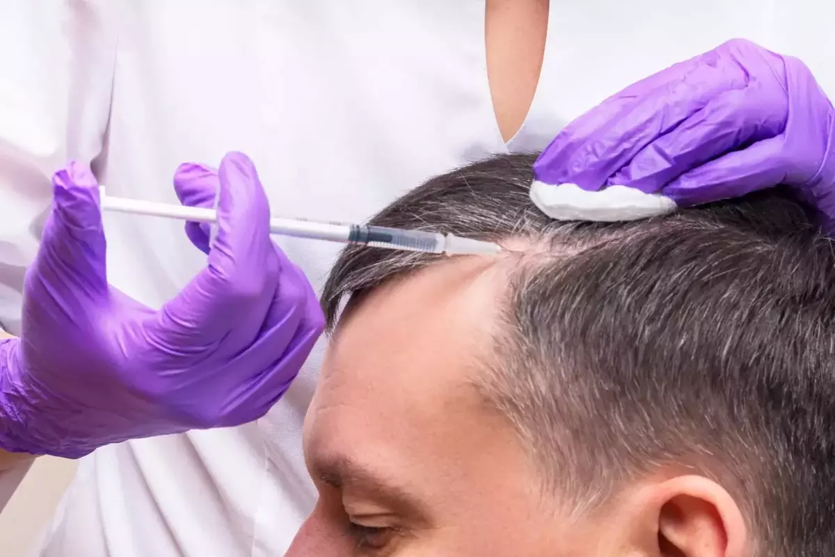 معالجة الشعر بواسطة الصفائح الغنية بالفيبرين: كل ما يجب عليك معرفته