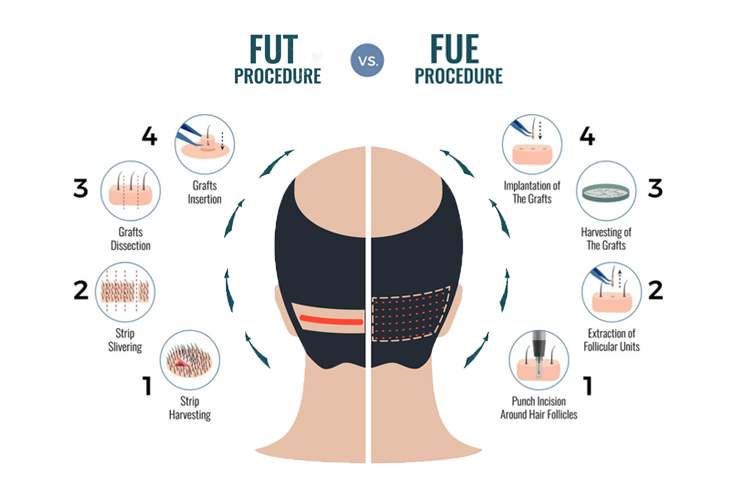 تقنيات زراعة الشعر FUT VS FUE