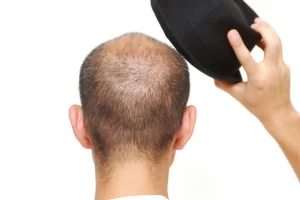 هل إرتداء القبعة يسبب تساقط الشعر؟ هل إرتداء القبعة يسبب تساقط الشعر؟