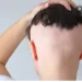 ماذا تعرف عن تساقط الشعر الرجعي Retrograde Alopecia؟