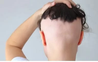 ماذا تعرف عن تساقط الشعر الرجعي Retrograde Alopecia؟